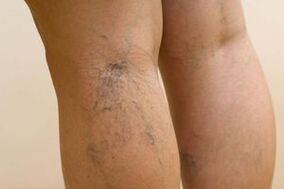 Comment les varices chez les femmes se manifestent