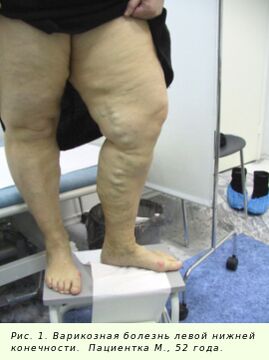 Les varices doivent être traitées pour arrêter le processus