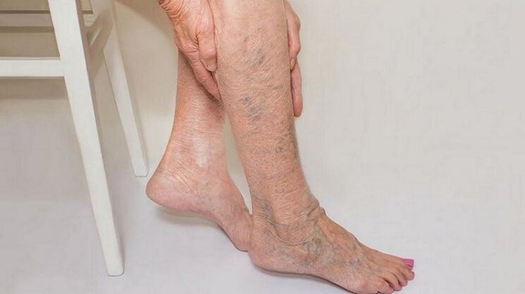 varices sur les jambes