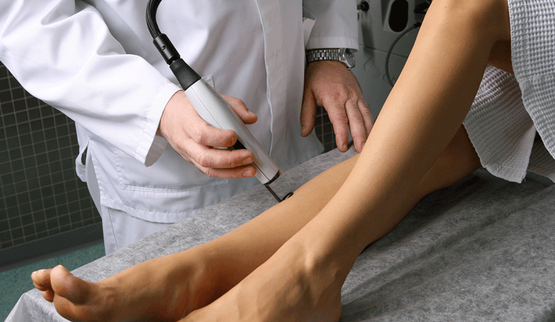 traitement au laser pour les varices
