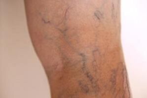 varices sur les jambes