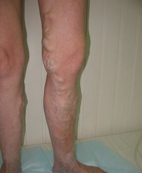 veines saillantes sur la jambe en raison de varices