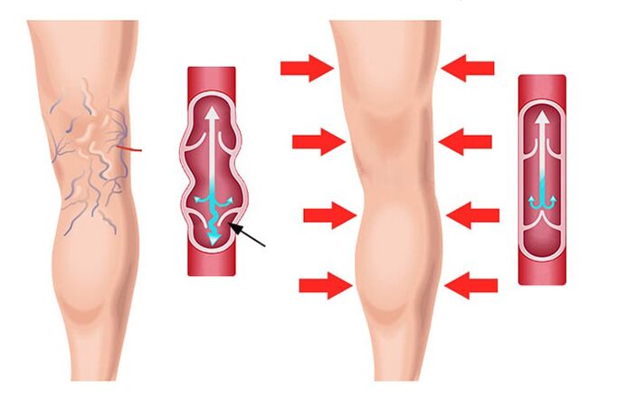 effet du gel Levicose dans le traitement